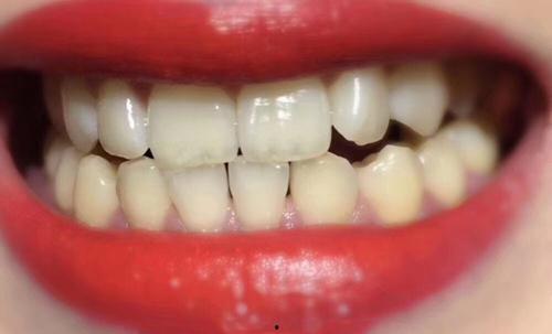 黄牙齿照片,从照片看牙齿美白之道